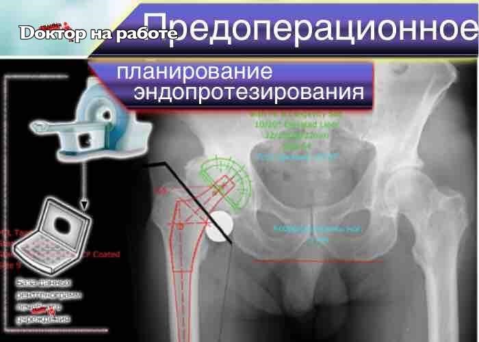 Бесцементный эндопротез тазобедренного сустава. Aesculap эндопротезы тазобедренного. Эндопротезирование тазобедренного сустава в москве по омс. Эндопротезирование тазобедренного сустава реабилитация. Дисплазия тазобедренных суставов рентген.