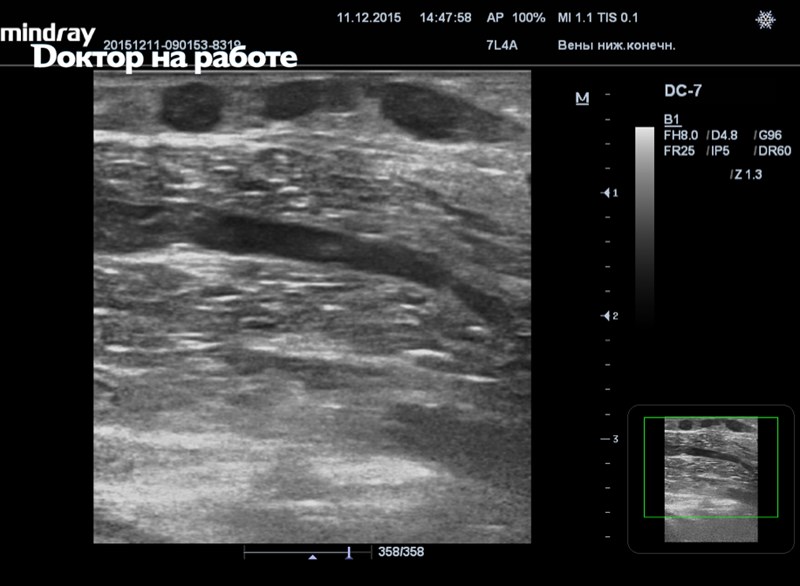 Узи вен тромбоз. Тромбоз глубоких вен нижних конечностей на УЗИ. Тромбоз суральных вен на УЗИ. Подколенная Вена тромбоз УЗИ.