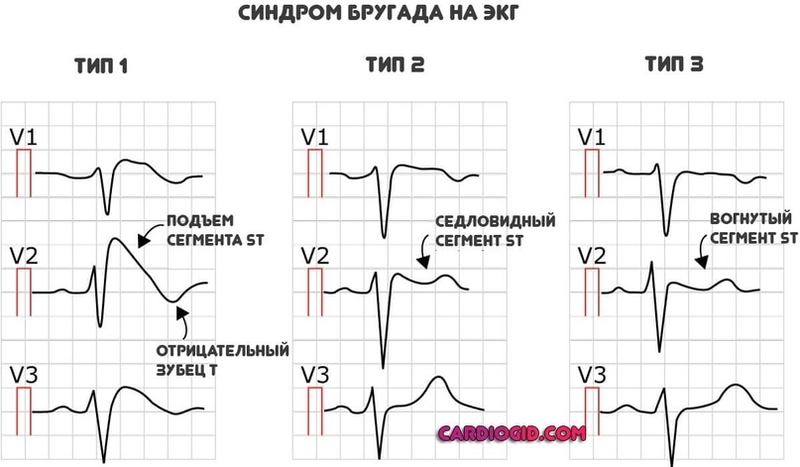 Блокада правой ножки пучка Гиса: диагностика и лечение