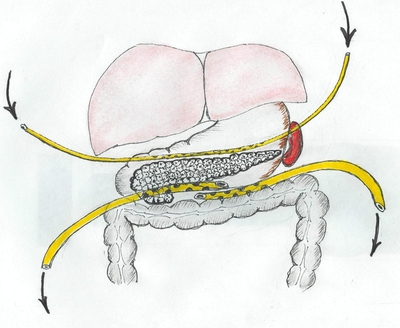 полуоткрытое дренирование при панкреонекрозе. дренирование кисты поджелудочной железы. пункция кисты поджелудочной железы под контролем узи. санториниев проток поджелудочной железы. «закрытый» метод дренирующих операций.