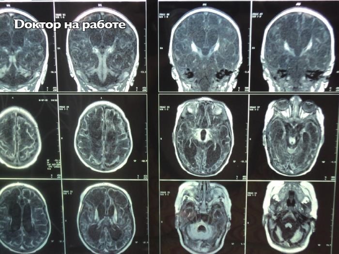 Опухоль головного мозга у ребенка фото