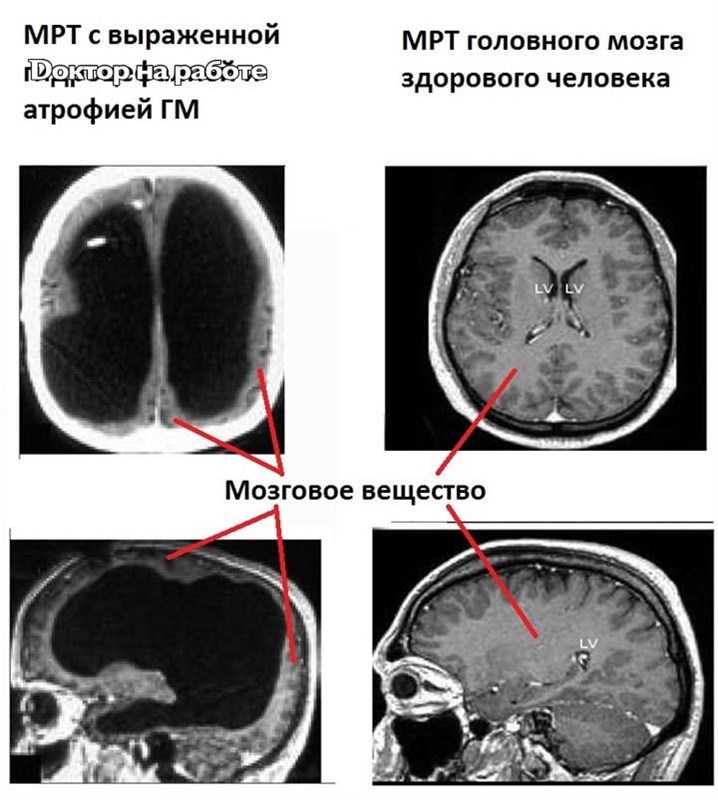 Умеренные атрофические изменения