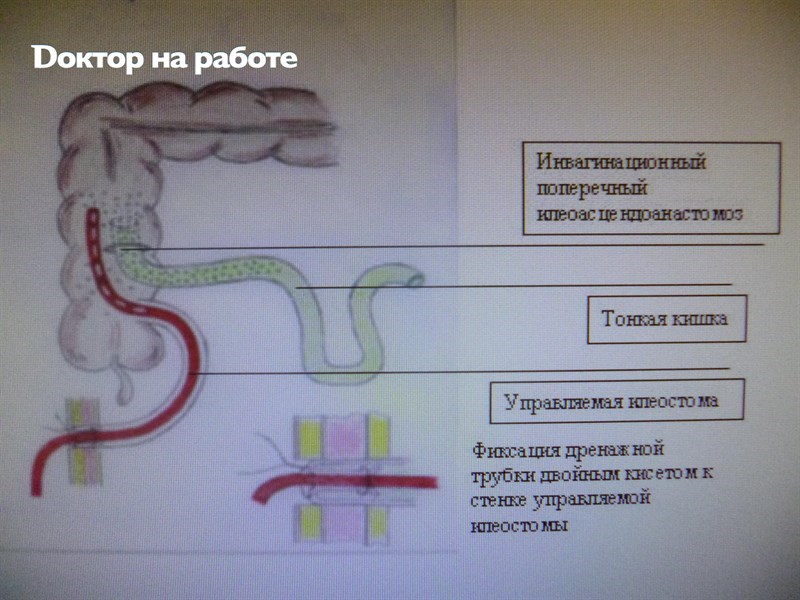 БАУГИНОПЛАСТИКА – МЕТОДИКА ХИРУРГИЧЕСКОЙ КОРРЕКЦИИ НЕДОСТАТОЧНОСТИ ИЛЕОЦЕКАЛЬНОГО КЛАПАНА