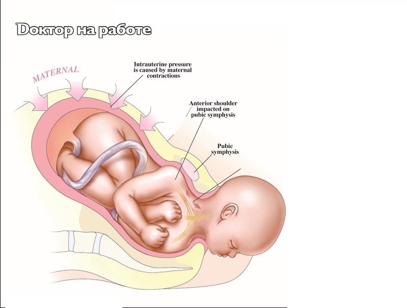 Дистоция. Manevry Makrobertsa pri distocii PLECHIKOV. Дистоция плечиков jpg.
